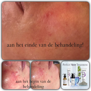 Rosacea enorm verminderd tijdens de eerste behandeling!